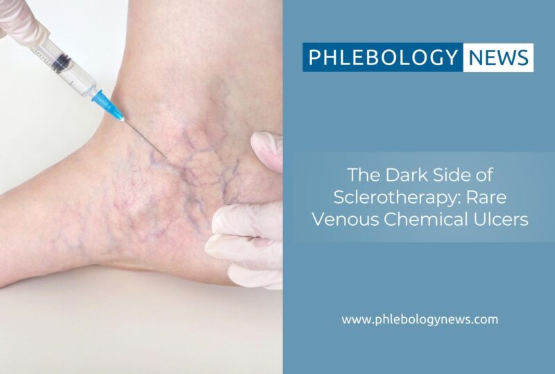 sclerotherapy rare dark side