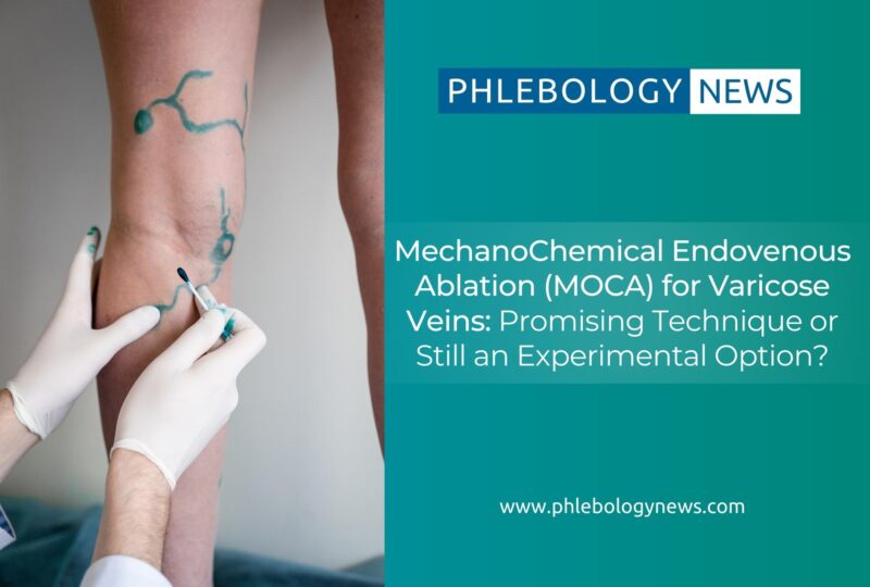 Phlebology News: MechanoChemical Endovenous Ablation (MOCA) for Varicose Veins: Promising Technique or Still an Experimental Option?