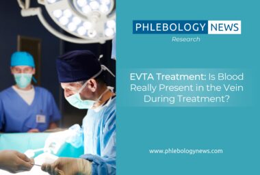 EVTA Treatment: Is Blood Really Present in the Vein During Treatment?