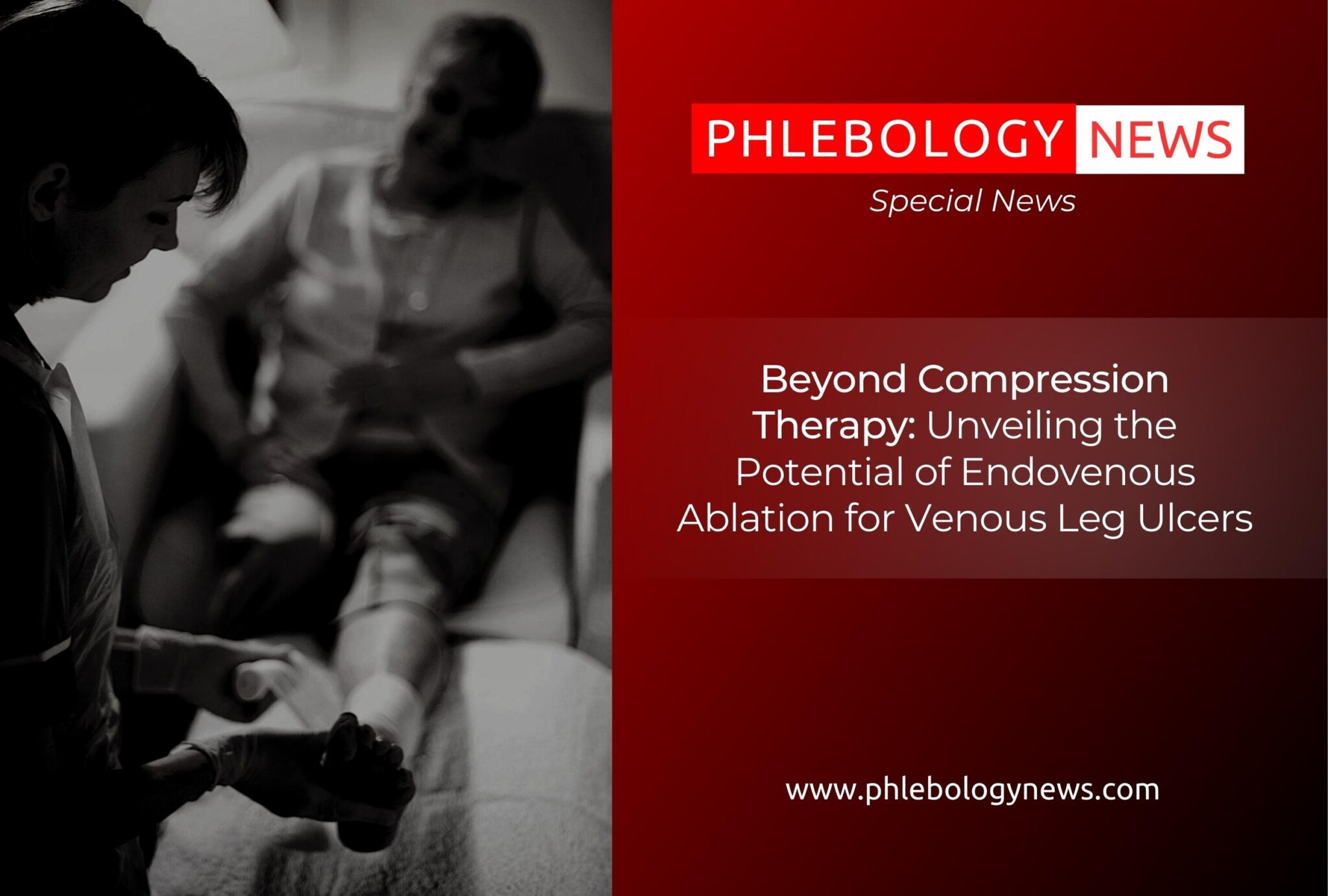 Beyond Compression Therapy Unveiling the Potential of Endovenous