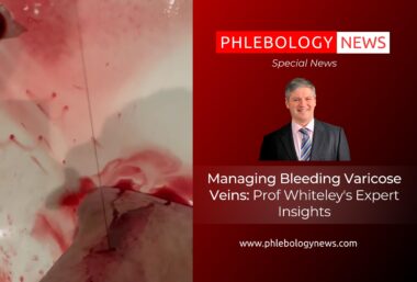 Managing Bleeding Varicose Veins: Prof Whiteley's Expert Insights