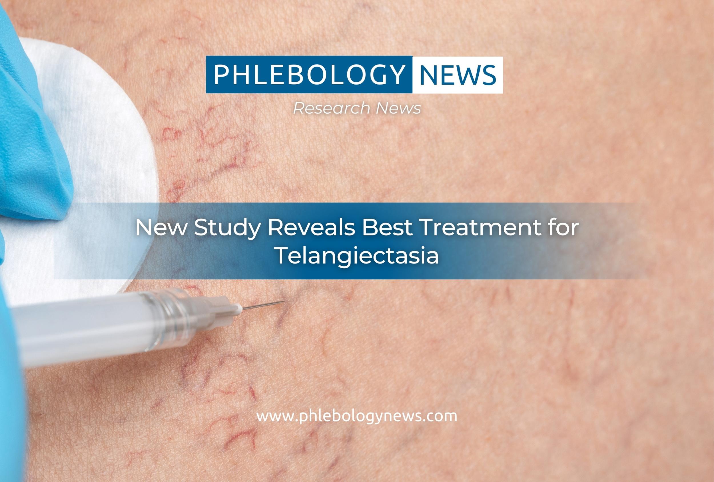 Teleangiectasy New Study Reveals Best Treatment for Telangiectasia – Phlebology News